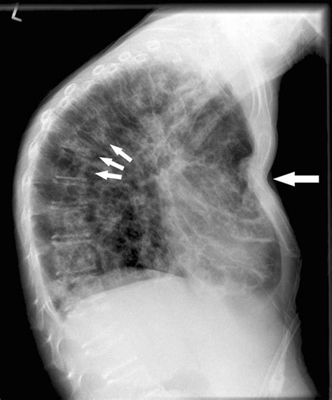 barrel compression test sternal fracture|sternum fracture prognosis.